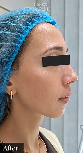 Косметология — После, SANLE Beauty Salon