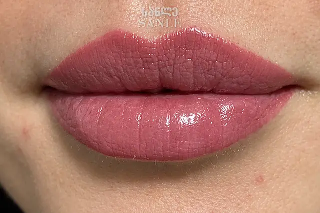 Lip filler — After, SANLE Beauty Salon