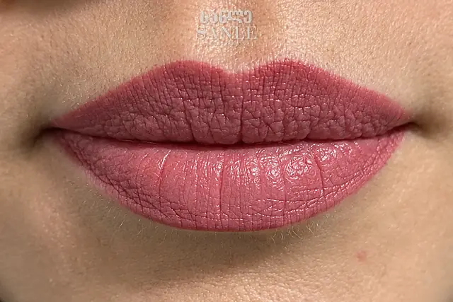 Lip filler — Before, SANLE Beauty Salon
