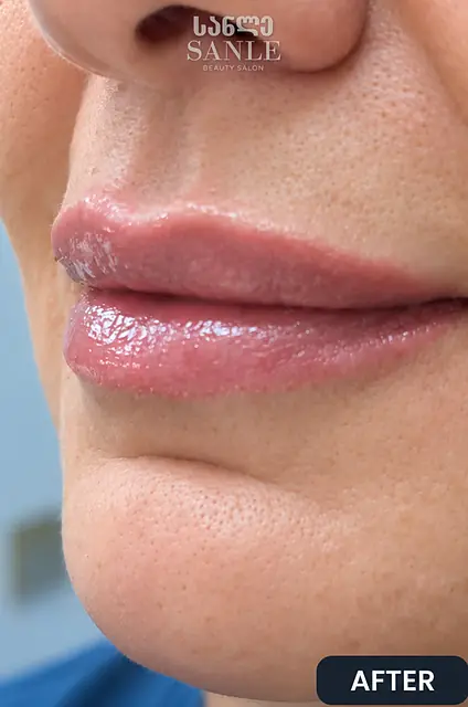 Lip filler — After, SANLE Beauty Salon