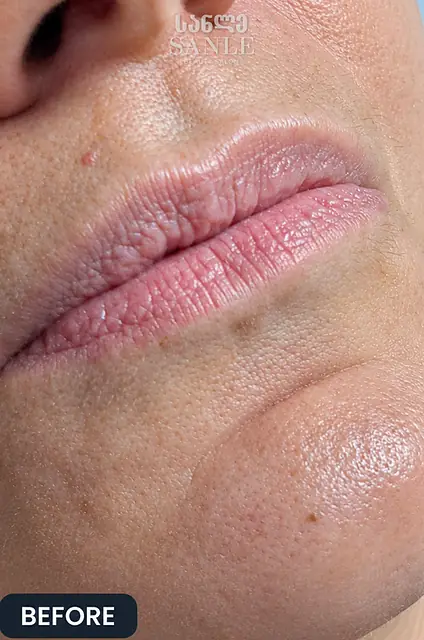 Lip filler — Before, SANLE Beauty Salon