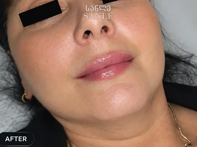 Lip filler — After, SANLE Beauty Salon