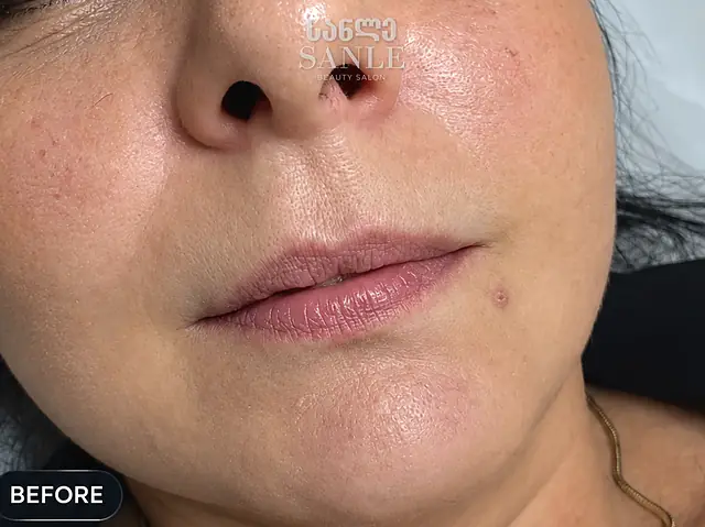 Lip filler — Before, SANLE Beauty Salon