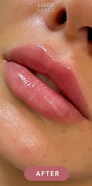 Lip filler — After, SANLE Beauty Salon