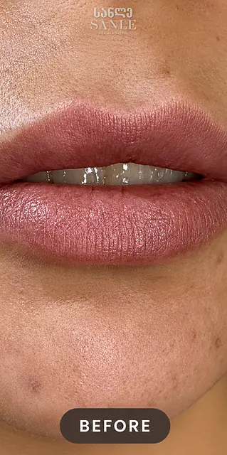 Lip filler — Before, SANLE Beauty Salon