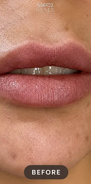 Контурная пластика губ — До, SANLE Beauty Salon