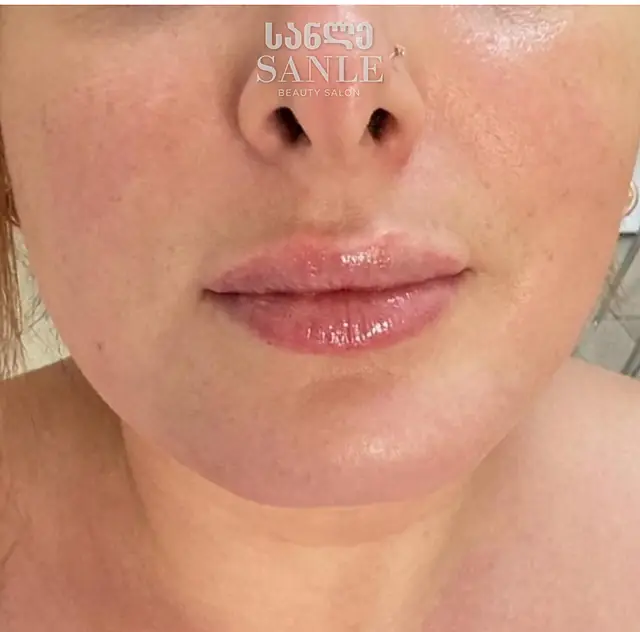 Lip filler — After, SANLE Beauty Salon