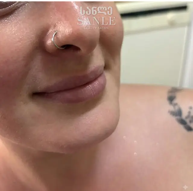 Lip filler — Before, SANLE Beauty Salon
