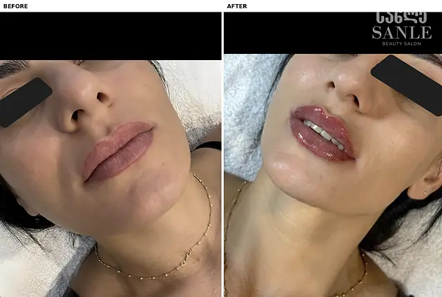 Косметология — SANLE Beauty Salon, Тбилиси