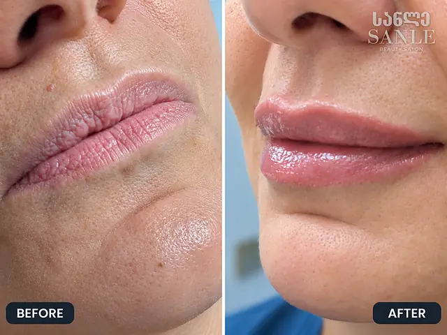 Косметология — SANLE Beauty Salon, Тбилиси