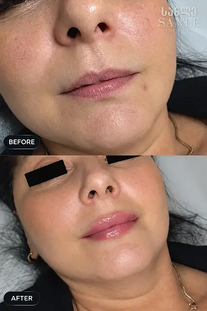 Косметология — SANLE Beauty Salon, Тбилиси